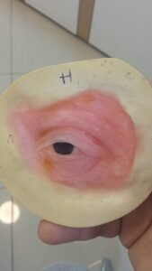 Optikara Open eyes " prothèse oculaire