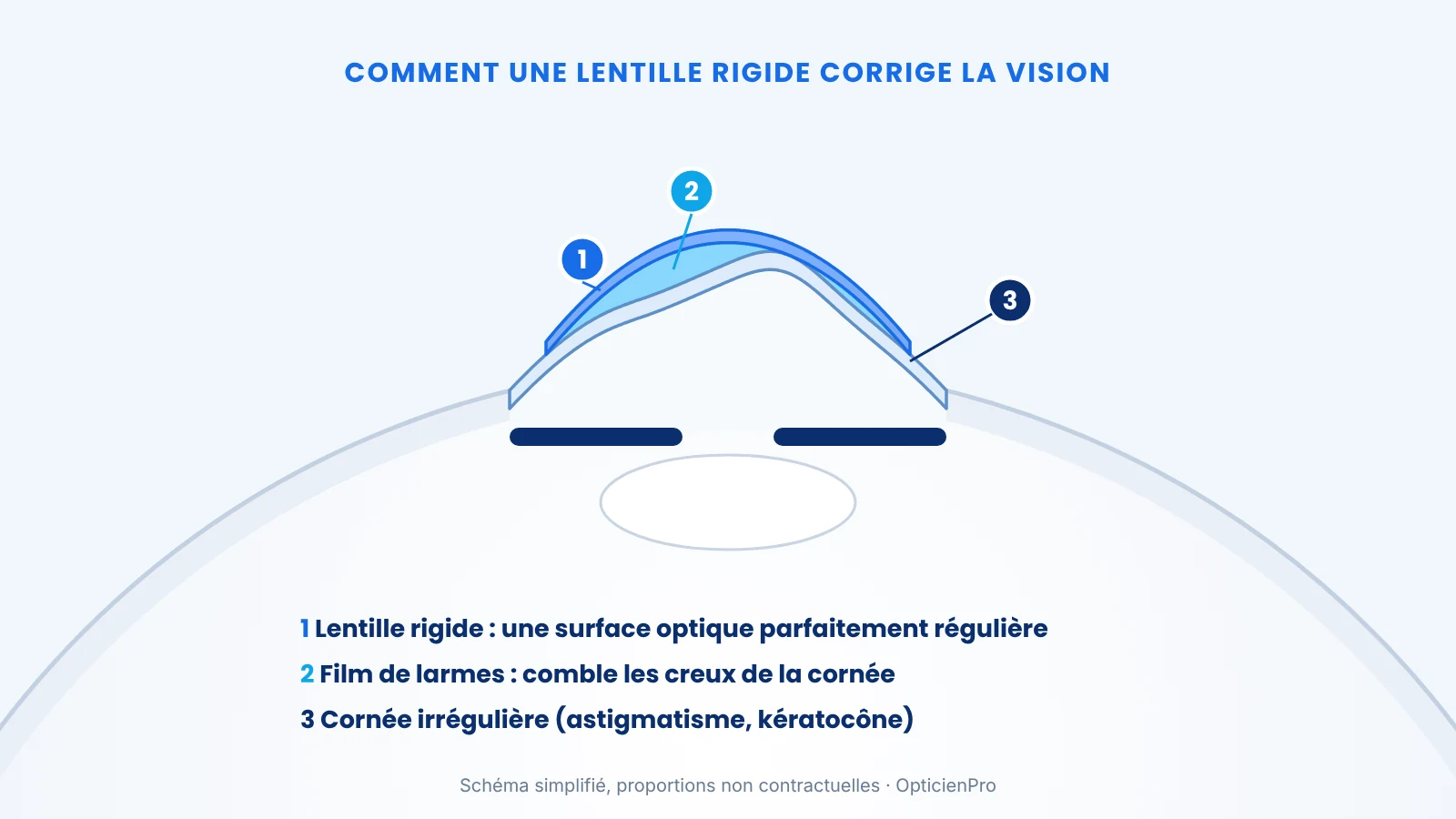 lentille-rigide-correction-astigmatisme-keratocone-schema